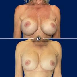 Capraro Plastic Surgery breast augmentation revision result — Denver, CO