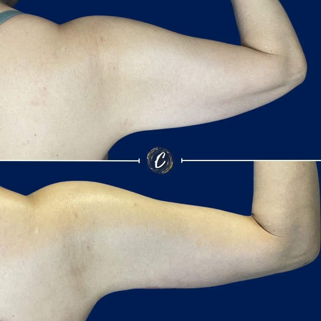 Capraro Plastic Surgery arm lift result — Denver, CO