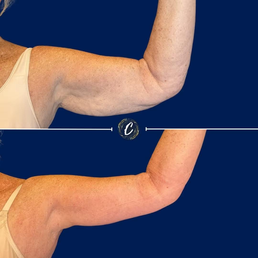 Capraro Plastic Surgery arm lift result — Denver, CO
