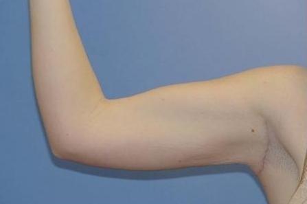 Thigh Lift after at Luxe Plastic Surgery in Sugar Land, TX
