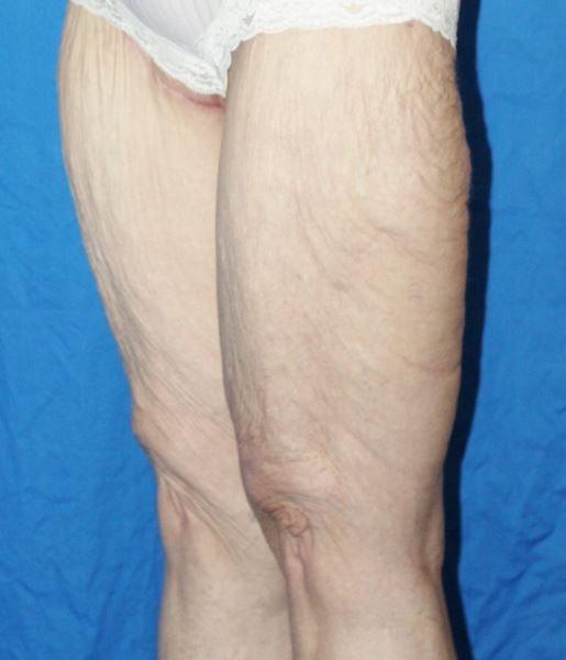 Luxe Plastic Surgery thigh lift after — Sugar Land, TX