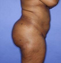 Luxe Plastic Surgery bbl after — Sugar Land, TX