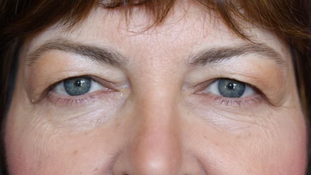 Blepharoplasty before at Luxe Plastic Surgery in Sugar Land, TX