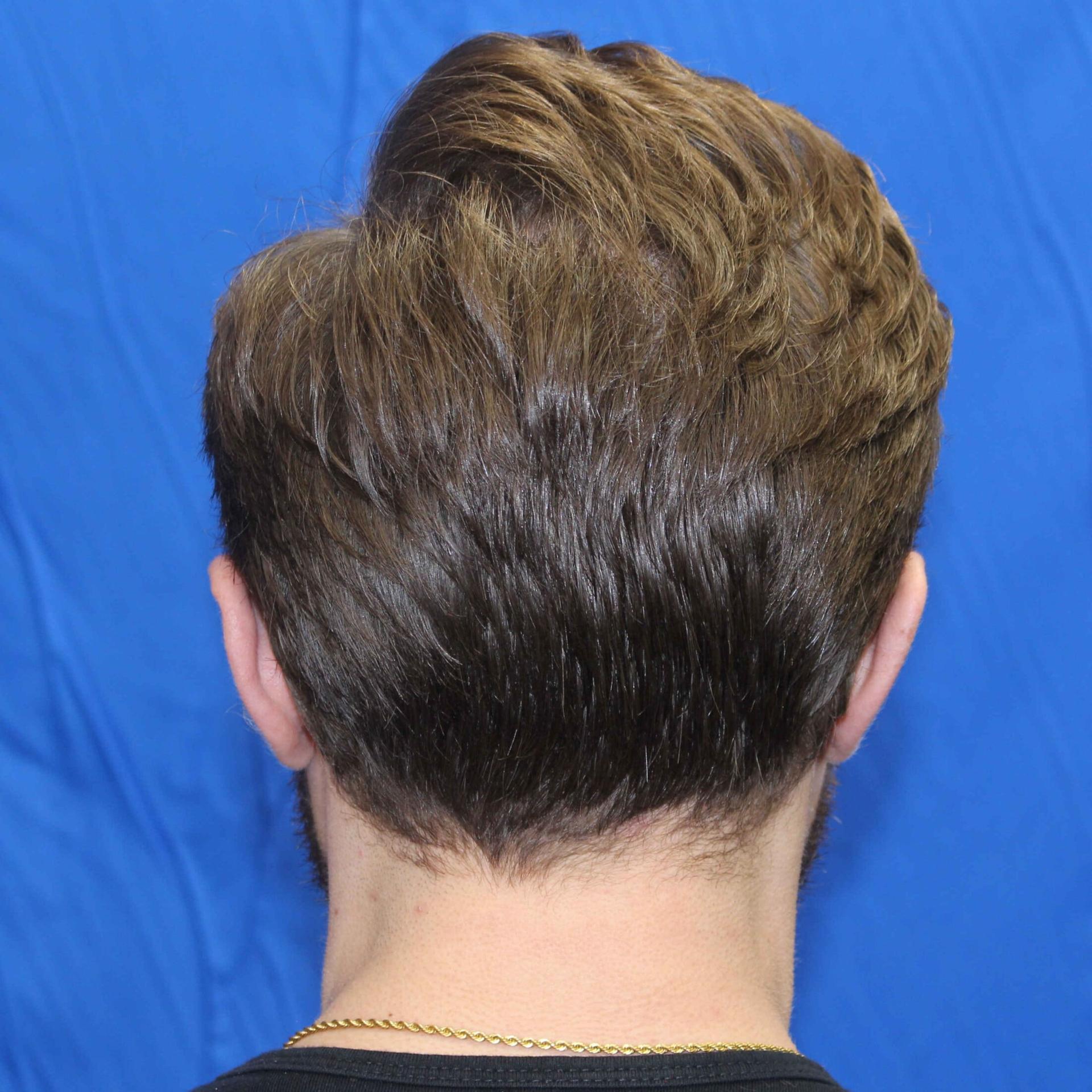 Luxe Plastic Surgery ear pinning after — Sugar Land, TX