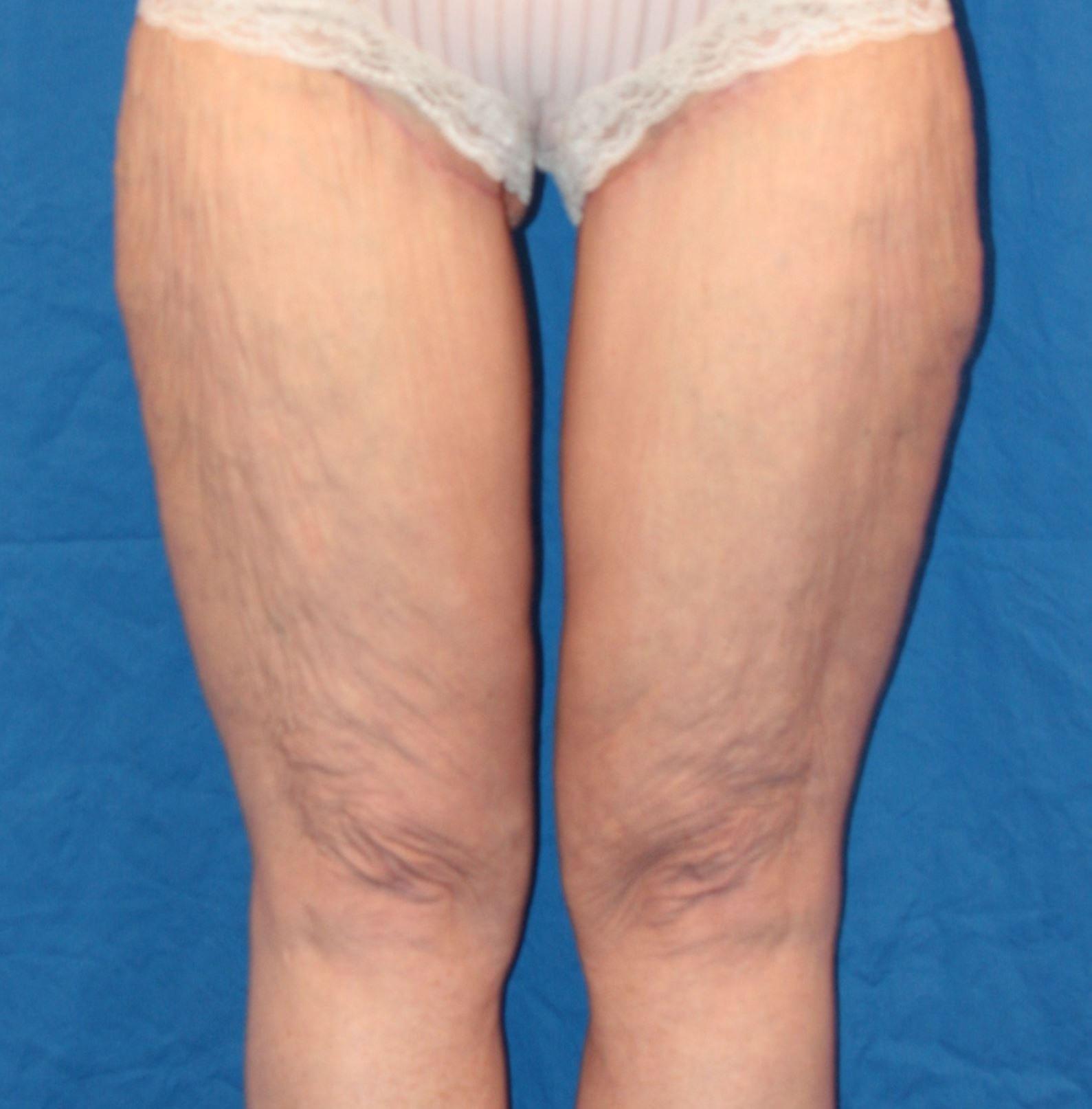 Luxe Plastic Surgery thigh lift after — Sugar Land, TX