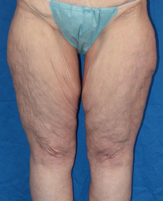 Thigh Lift before at Luxe Plastic Surgery in Sugar Land, TX