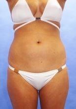 Liposuction before at Luxe Plastic Surgery in Sugar Land, TX