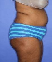 Brazilian Butt Lift before at Luxe Plastic Surgery in Sugar Land, TX