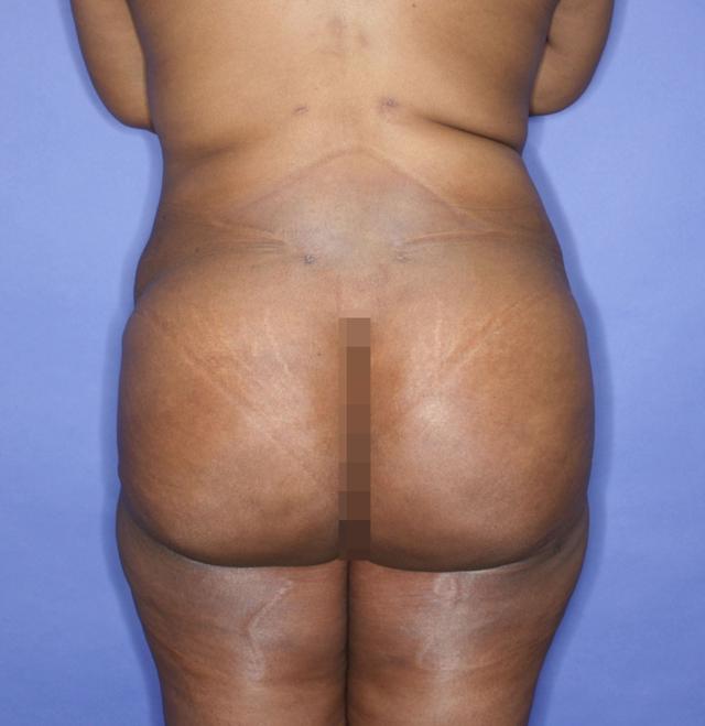 Brazilian Butt Lift after at Luxe Plastic Surgery in Sugar Land, TX