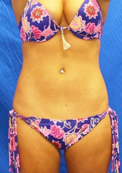 Liposuction after at Luxe Plastic Surgery in Sugar Land, TX