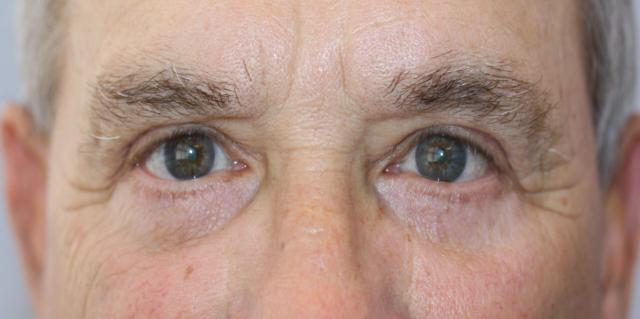 Blepharoplasty after at Luxe Plastic Surgery in Sugar Land, TX