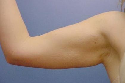 Thigh Lift before at Luxe Plastic Surgery in Sugar Land, TX