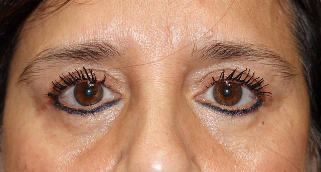 Blepharoplasty after at Luxe Plastic Surgery in Sugar Land, TX