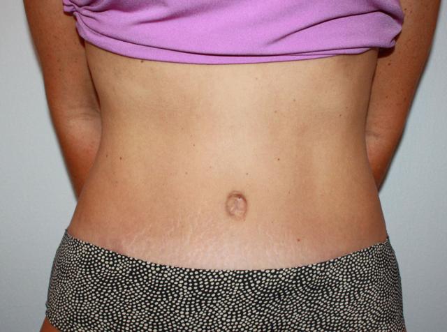Mini Tummy Tuck after at Luxe Plastic Surgery in Sugar Land, TX