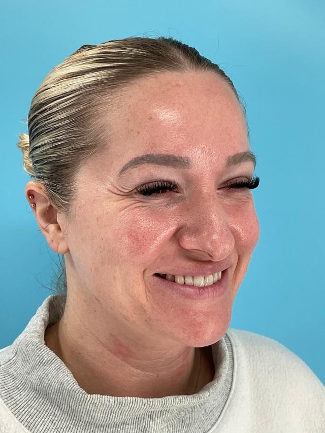 Botox before at Elysian Wellness & Aesthetics in Oklahoma City, OK
