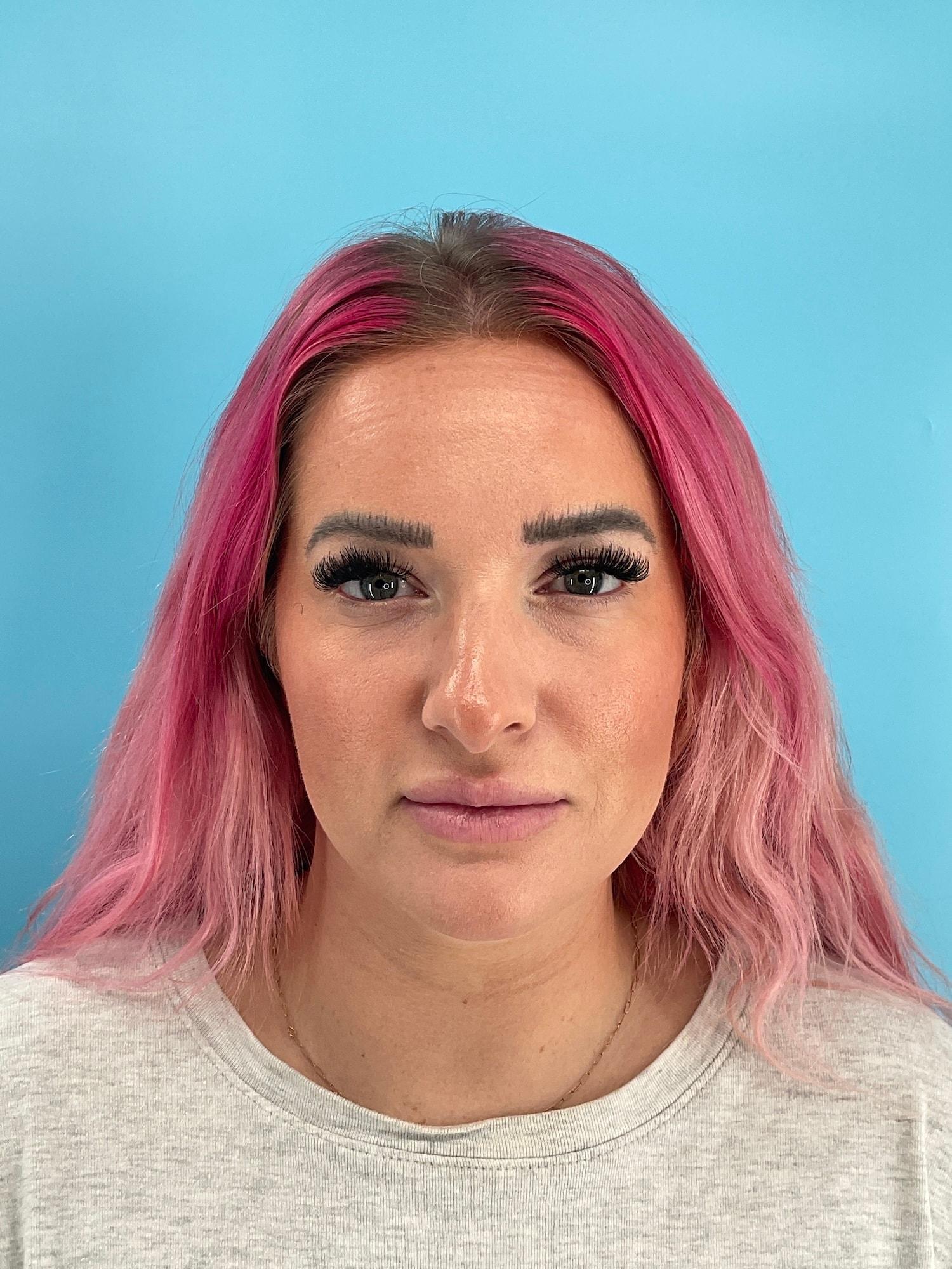 Elysian Wellness & Aesthetics lip filler after — Oklahoma City, OK