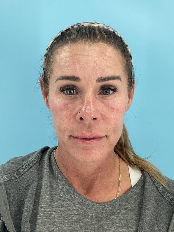 Elysian Wellness & Aesthetics botox after — Oklahoma City, OK