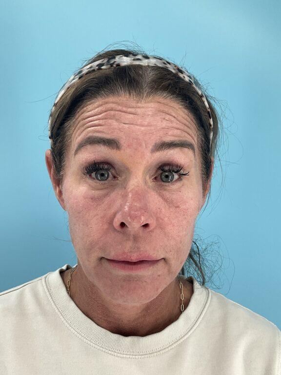Botox before at Elysian Wellness & Aesthetics in Oklahoma City, OK