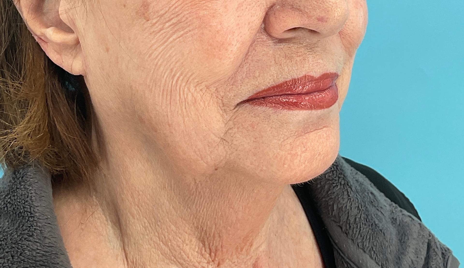 Elysian Wellness & Aesthetics photofacial after — Oklahoma City, OK