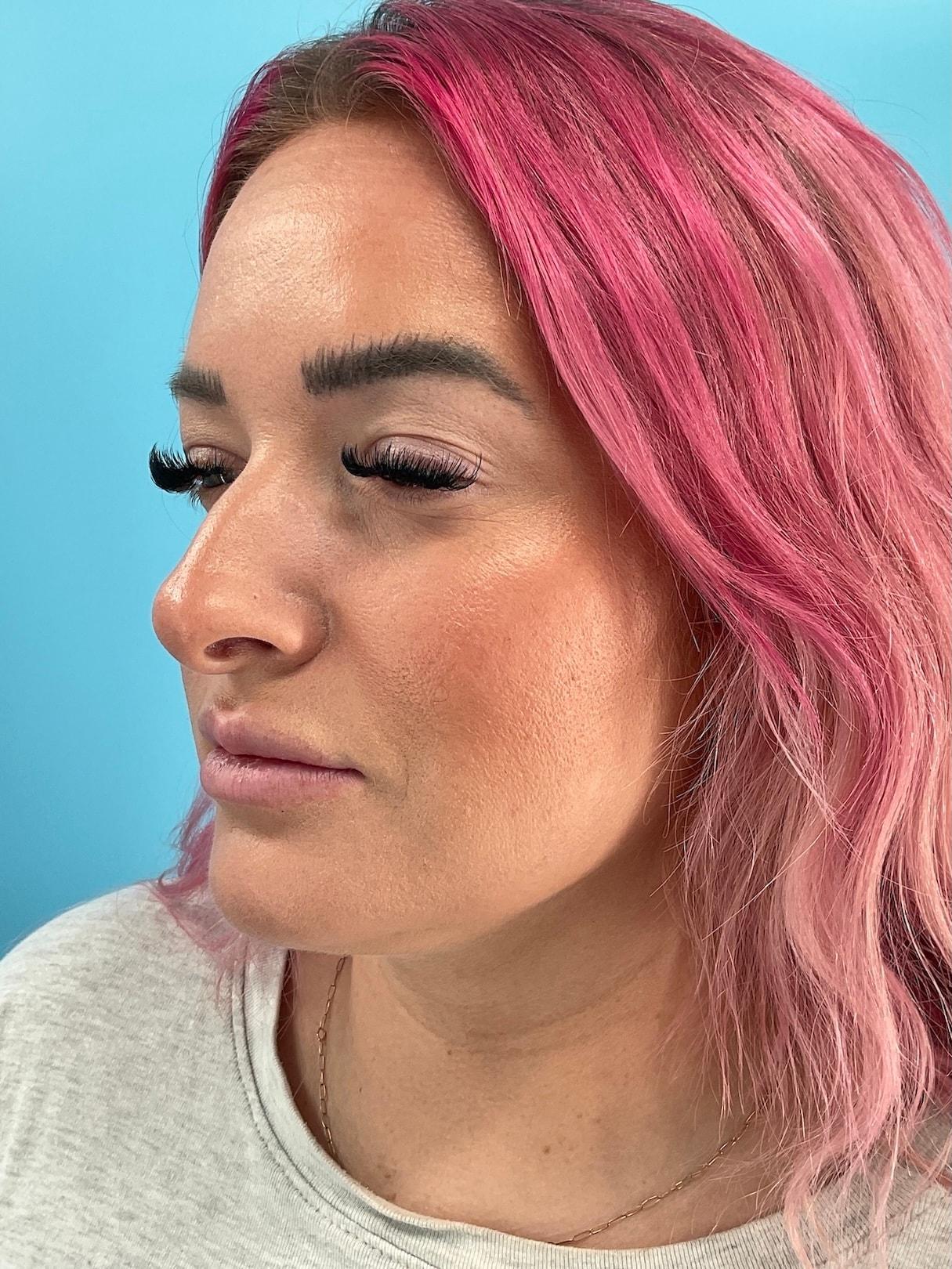 Elysian Wellness & Aesthetics lip filler after — Oklahoma City, OK