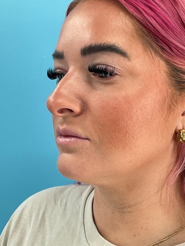 Lip Filler before at Elysian Wellness & Aesthetics in Oklahoma City, OK