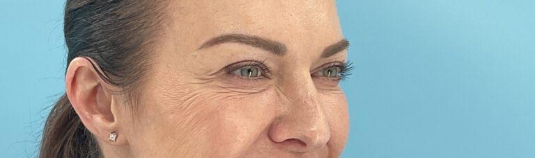 Elysian Wellness & Aesthetics botox after — Oklahoma City, OK