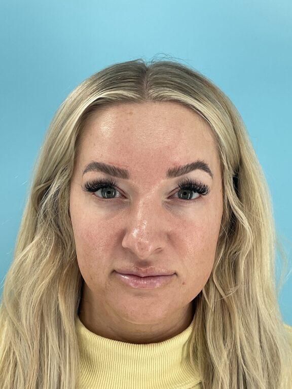 Elysian Wellness & Aesthetics botox after — Oklahoma City, OK