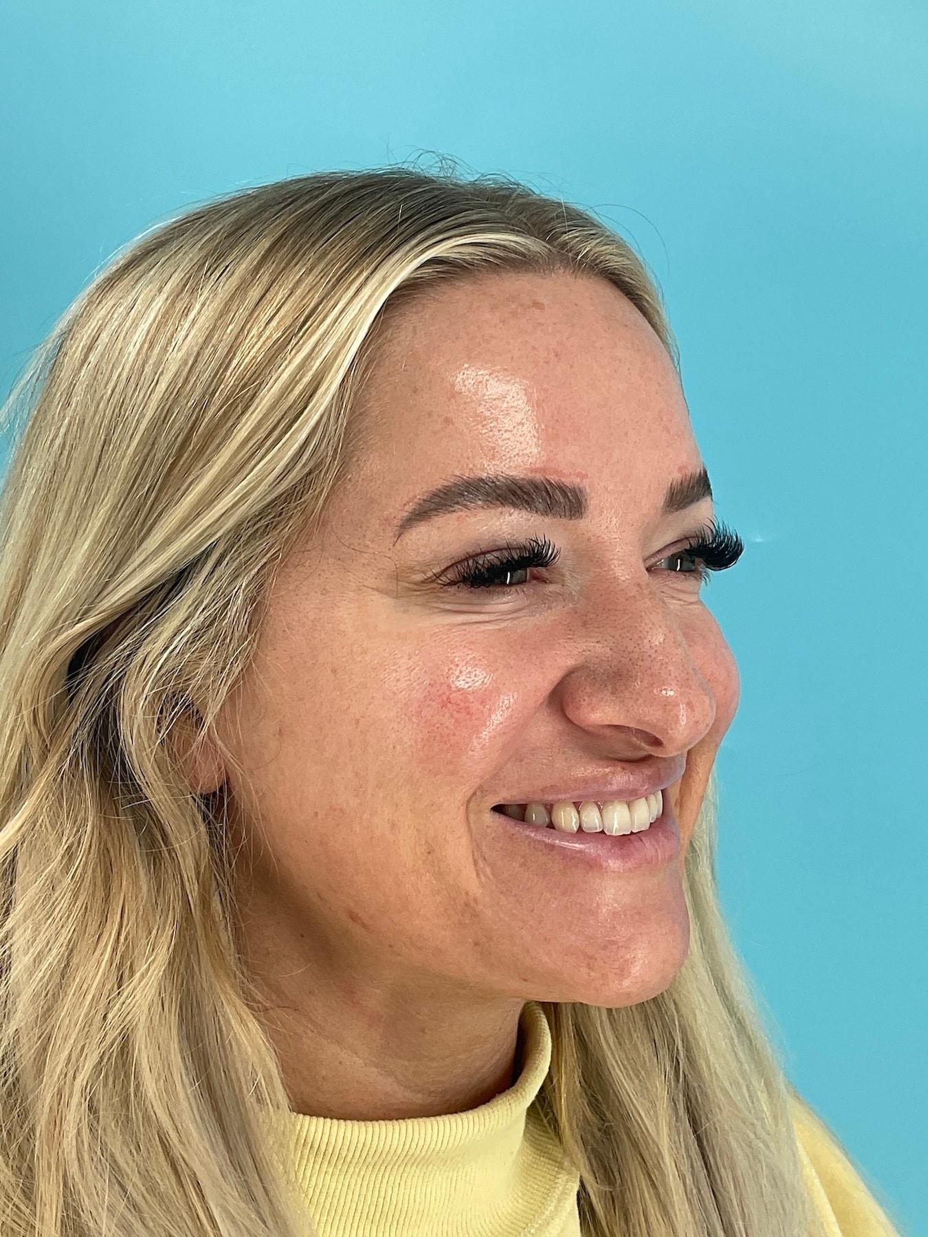 Elysian Wellness & Aesthetics botox after — Oklahoma City, OK