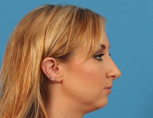 Functional Rhinoplasty after at CARE Plastic Surgery in Cary, NC