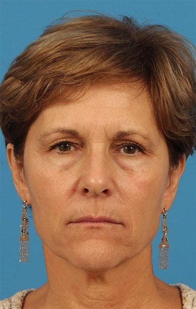 Brow Lift before at CARE Plastic Surgery in Cary, NC