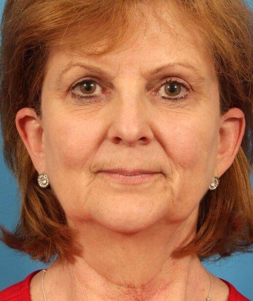 Neck Lift before at CARE Plastic Surgery in Cary, NC