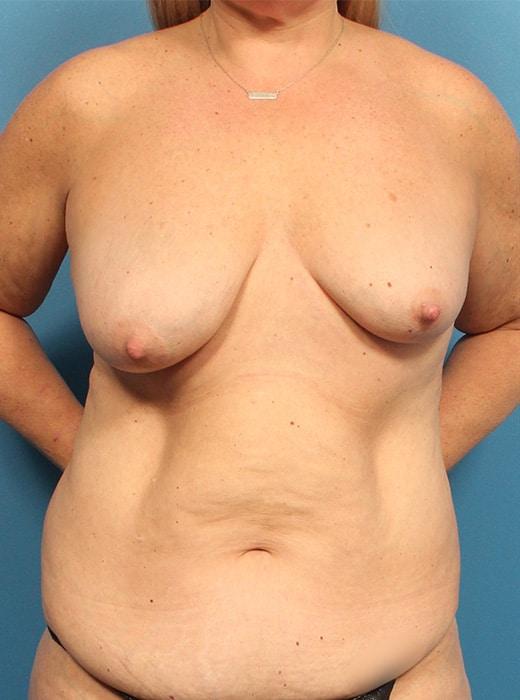 Breast Augmentation before at CARE Plastic Surgery in Cary, NC