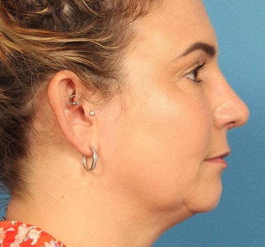 Functional Rhinoplasty after at CARE Plastic Surgery in Cary, NC