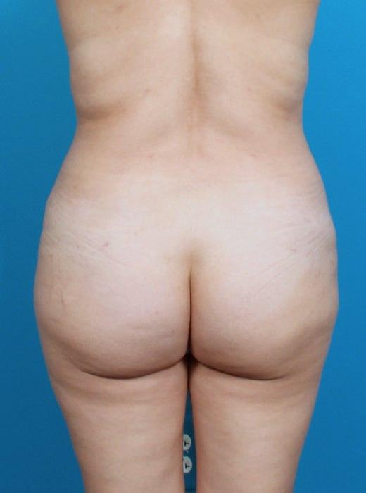 Brazilian Butt Lift before at CARE Plastic Surgery in Cary, NC