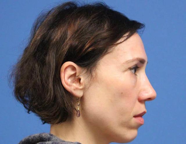 Functional Rhinoplasty before at CARE Plastic Surgery in Cary, NC