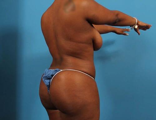 Brazilian Butt Lift after at CARE Plastic Surgery in Cary, NC