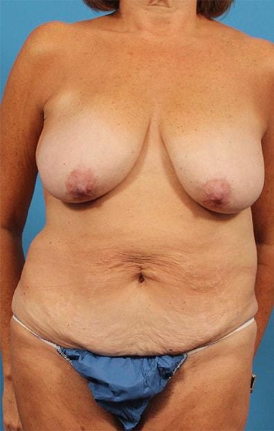 Mommy Makeover before at CARE Plastic Surgery in Cary, NC