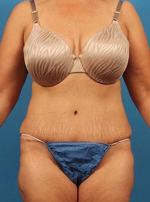 Mini Tummy Tuck after at CARE Plastic Surgery in Cary, NC