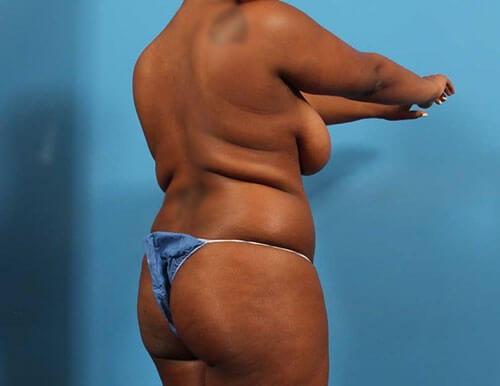Brazilian Butt Lift before at CARE Plastic Surgery in Cary, NC