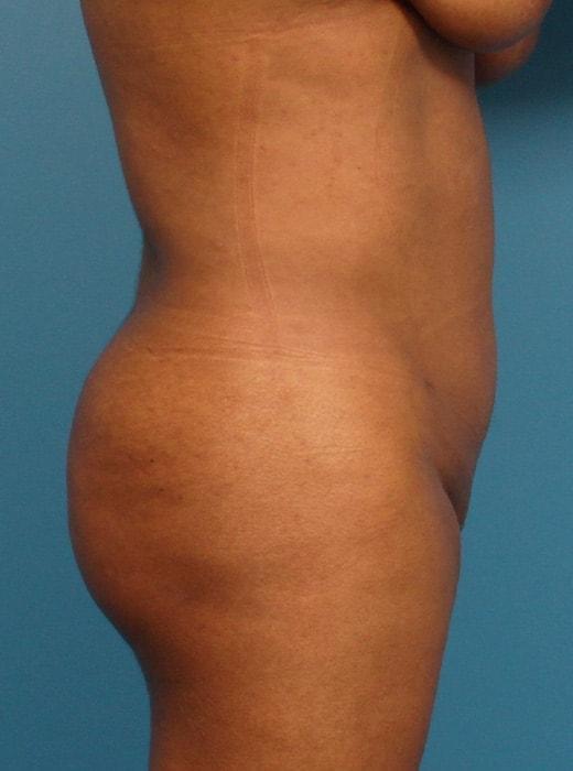 Brazilian Butt Lift after at CARE Plastic Surgery in Cary, NC