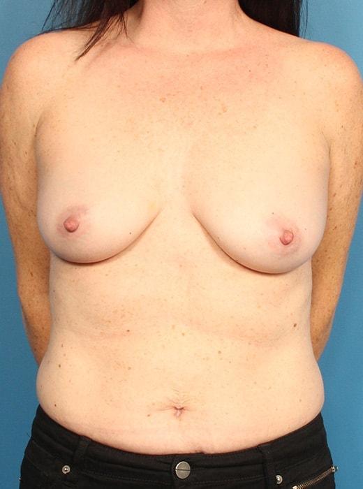 Fat Transfer Breast Augmentation before at CARE Plastic Surgery in Cary, NC