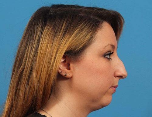 Functional Rhinoplasty before at CARE Plastic Surgery in Cary, NC