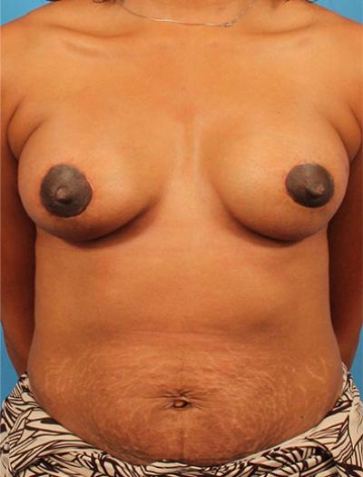 CARE Plastic Surgery breast augmentation after — Cary, NC