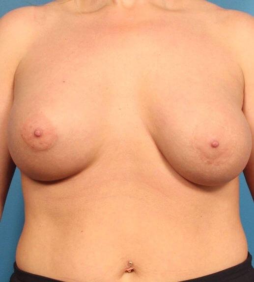 Fat Transfer Breast Augmentation after at CARE Plastic Surgery in Cary, NC