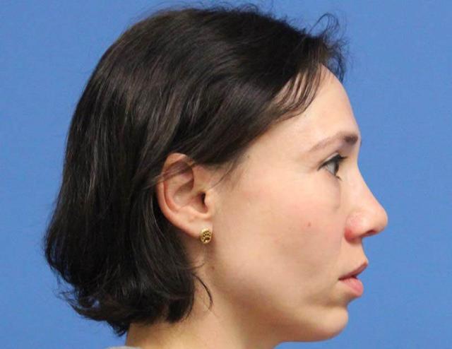 Functional Rhinoplasty after at CARE Plastic Surgery in Cary, NC
