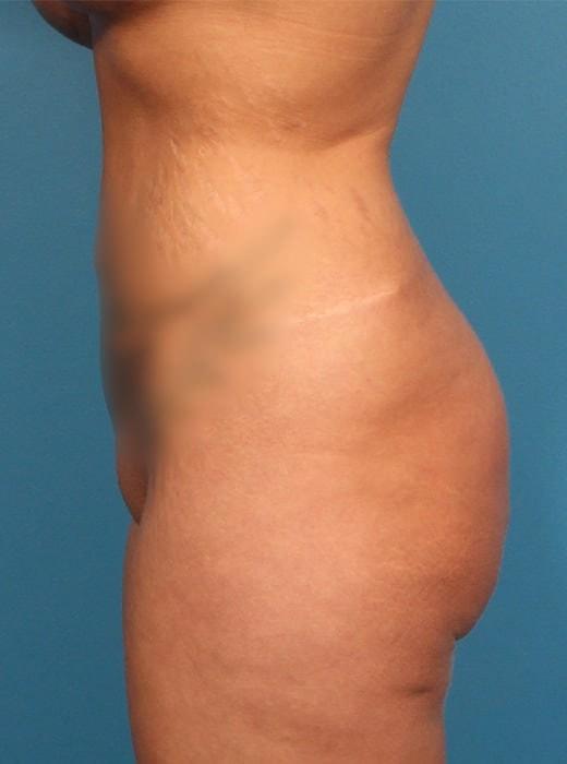 Brazilian Butt Lift before at CARE Plastic Surgery in Cary, NC