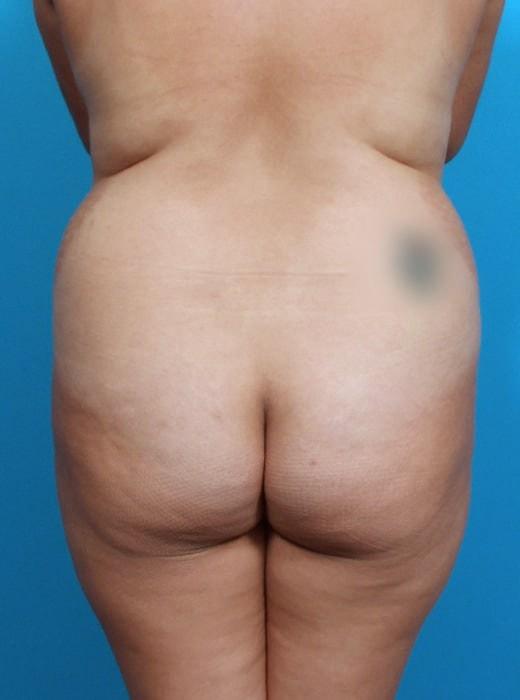 Brazilian Butt Lift before at CARE Plastic Surgery in Cary, NC
