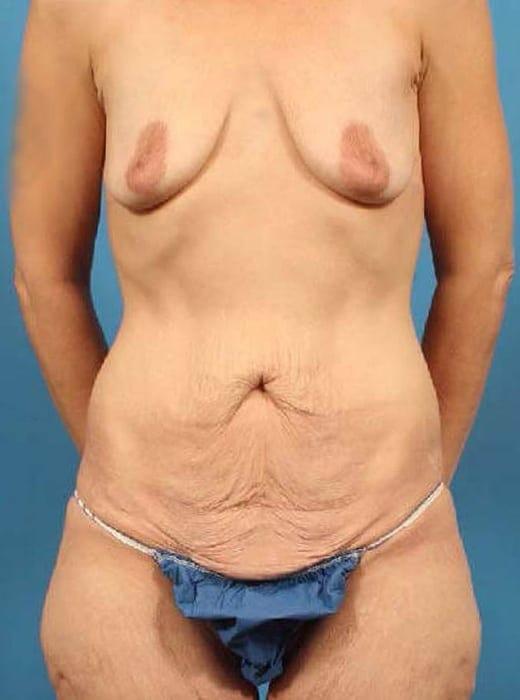 Mini Tummy Tuck before at CARE Plastic Surgery in Cary, NC