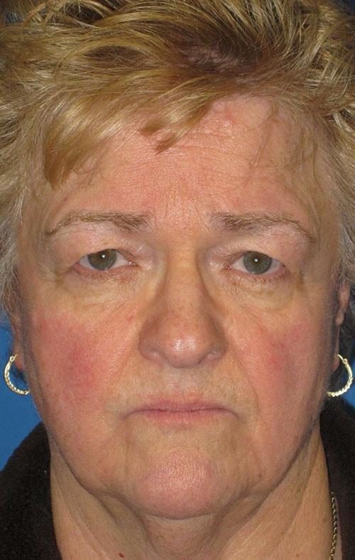 Brow Lift before at CARE Plastic Surgery in Cary, NC