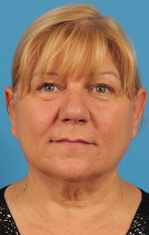 CARE Plastic Surgery fat transfer after — Cary, NC